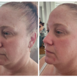 What Is Skin Tightening Treatment & Its Benefits?