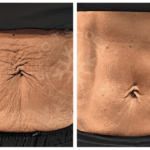 T-Shock Cryotherapy vs. Traditional Cryotherapy: Key Differences Explained