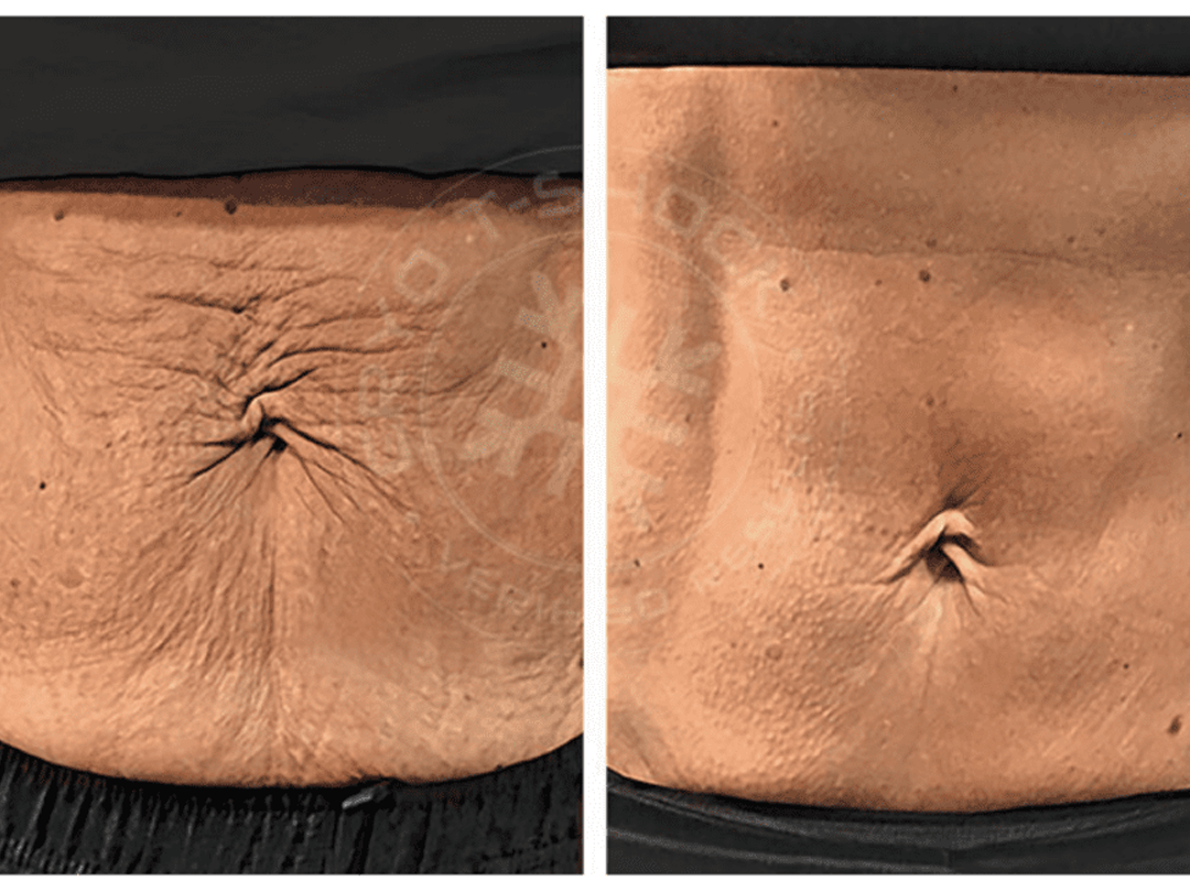 T-Shock Cryotherapy vs. Traditional Cryotherapy: Key Differences Explained