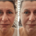 Wrinkle Reduction Without Surgery: Best Non-Invasive Treatments in 2026