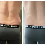 How Many Sessions Are Needed For RF Cellulite Treatment?