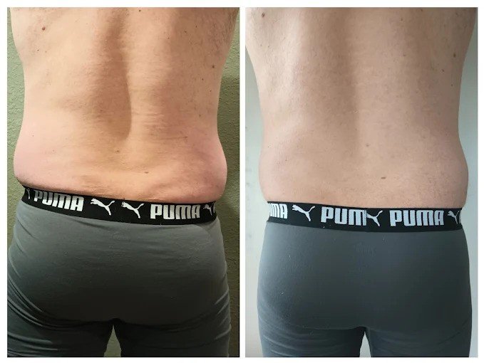 How Many Sessions Are Needed For RF Cellulite Treatment?