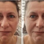 At-Home Vs Professional Wrinkle Treatments
