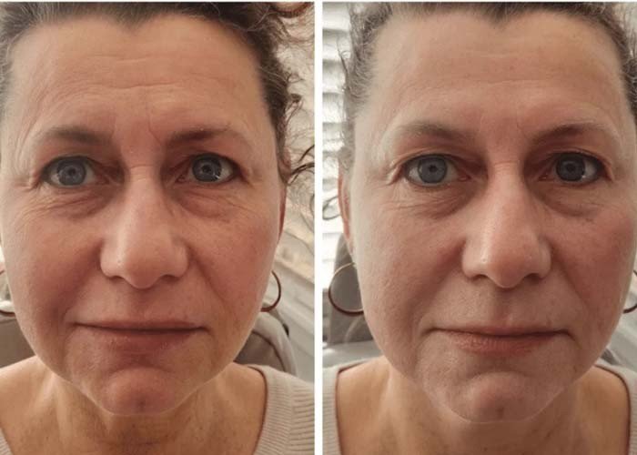 At-Home Vs Professional Wrinkle Treatments